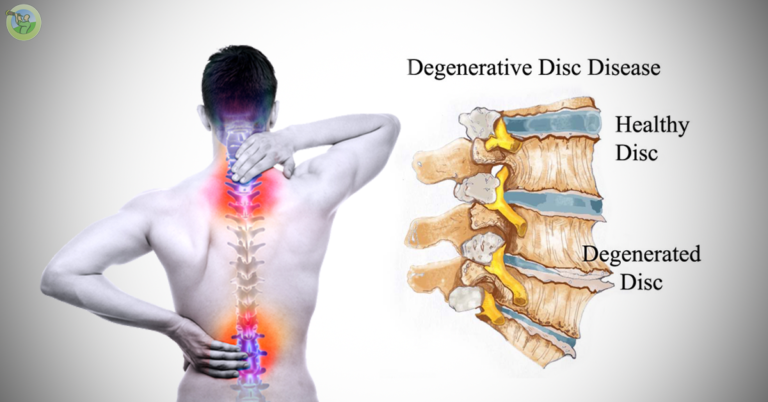 Degenerative-Disk-Disease