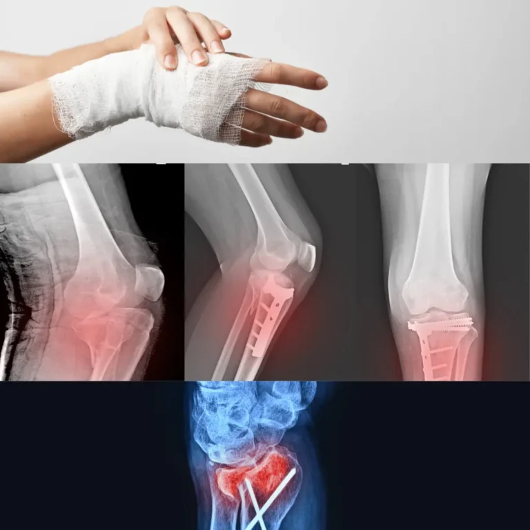What-is-bone-fracture-repair-surgery